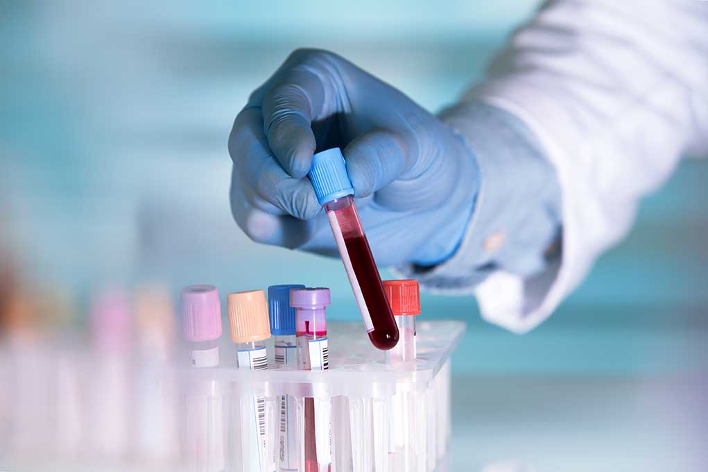 441264445 featured image Gloved hand holding a blood sample test tube.