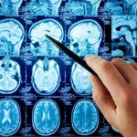 Startling Parkinson’s Connection Alarms Scientists Hand pointing at brain scan images on screen