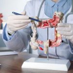Silent Cancer Wave Hits Millennials Doctor pointing at anatomical model of the colon.