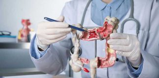 Silent Cancer Wave Hits Millennials Doctor pointing at anatomical model of the colon.